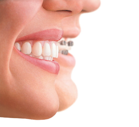 ¿Ortodoncia con alineadores o brackets?